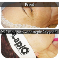 Urządzenie kosmetyczne Lapio Pro BODY Fit© / obudowa biała lub czarna