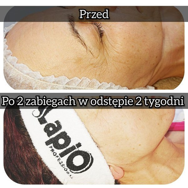 Urządzenie kosmetyczne Lapio Pro BODY Fit© / obudowa biała lub czarna